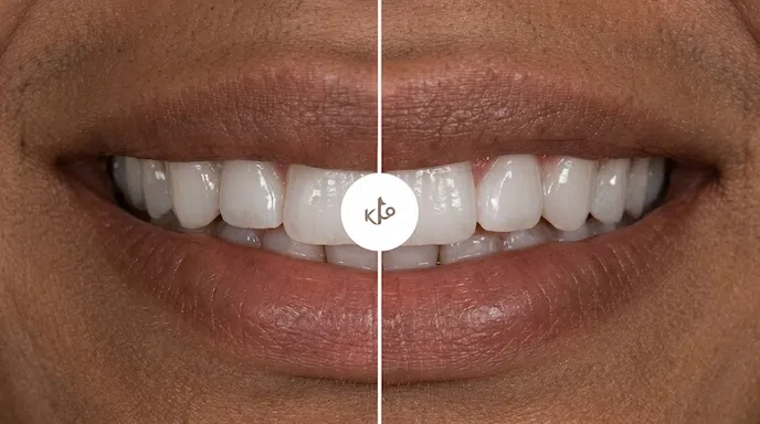Antes e depois do tratamento de odontologia estética de facetas de resina.
