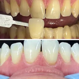 Procedimento odontológico de clareamento dental, antes e após o resultado feito pelo dentista Gustavo Lizarelli em Ribeirão Preto.