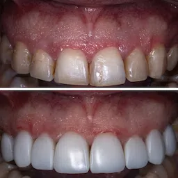 Procedimento odontológico de facetas de resina, antes e após o resultado feito pelo dentista Gustavo Lizarelli em Ribeirão Preto.