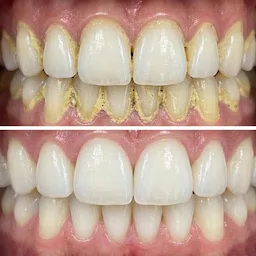 Procedimento odontológico de limpeza dentária, antes e após o resultado feito pelo dentista Gustavo Lizarelli em Ribeirão Preto.