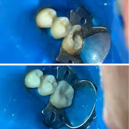 Procedimento odontológico de restauração dentária, antes e após o resultado feito pelo dentista Gustavo Lizarelli em Ribeirão Preto.