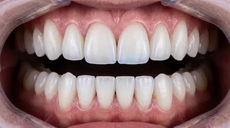 Aprimoramento estético com facetas de resina feitas com dentista em Ribeirão Preto.