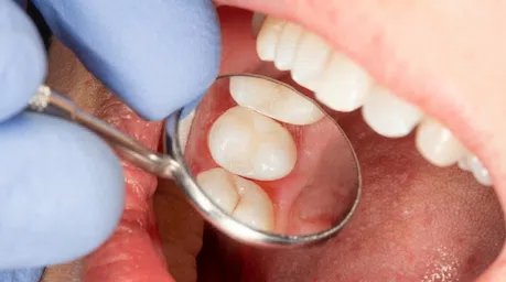 Precisão e estética em restauração dentária em Ribeirão Preto.