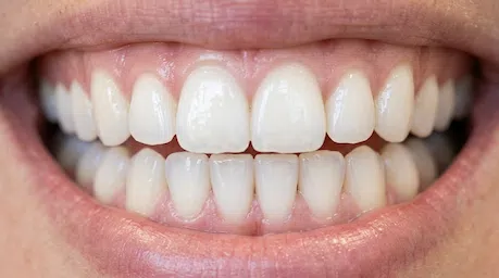 Sorriso mais limpo e branco após limpeza dentária em Ribeirão Preto feita pelo dentista Dr. Gustavo Lizarelli.