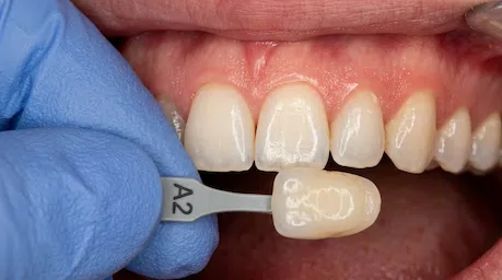 Técnicas modernas em restauração dentária em Ribeirão Preto.