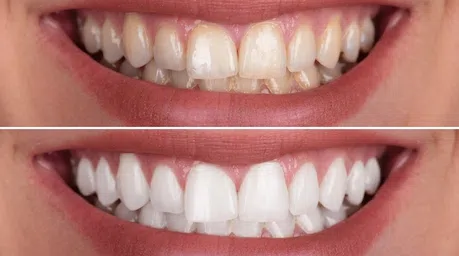 Técnicas seguras e modernas para clareamento dental em Ribeirão Preto. Feito com total profissionalismo no consultório odontológico do Dr. Gustavo Lizarelli dentista.